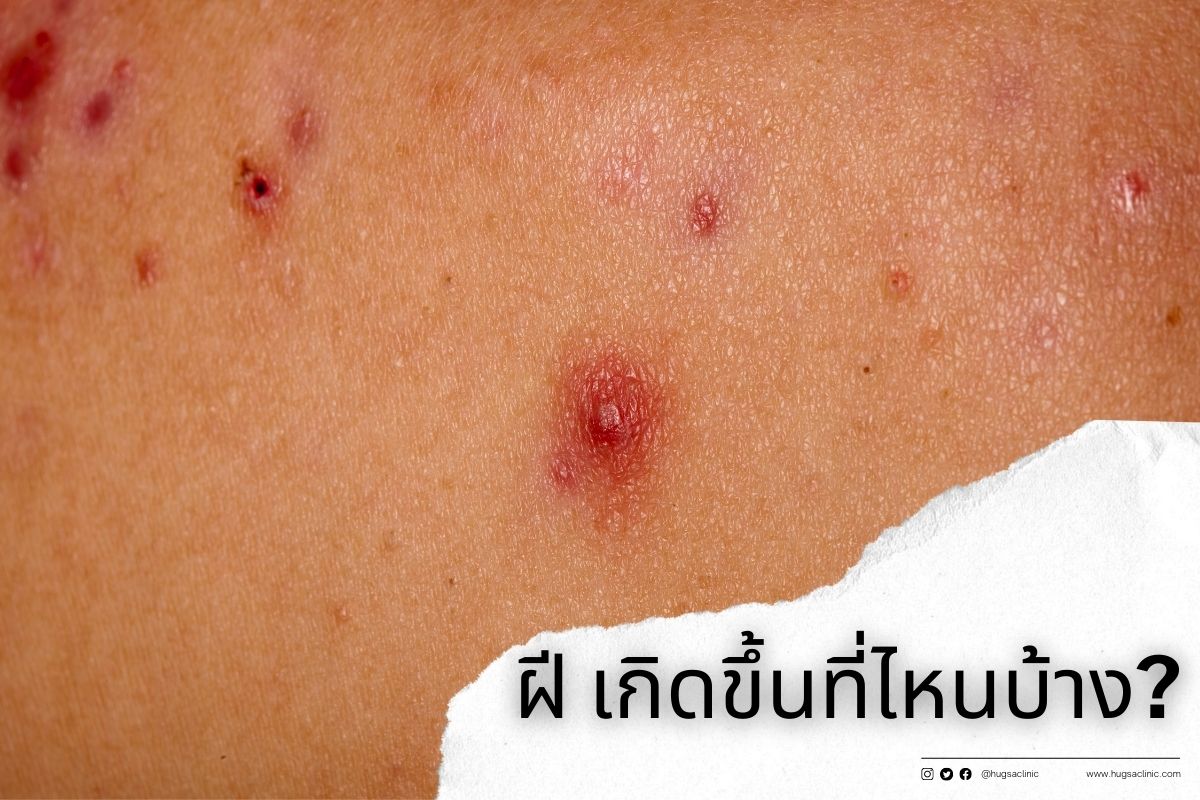 ฝี (Abscess) : ฮักษา คลินิก [Hugsa Clinic]
