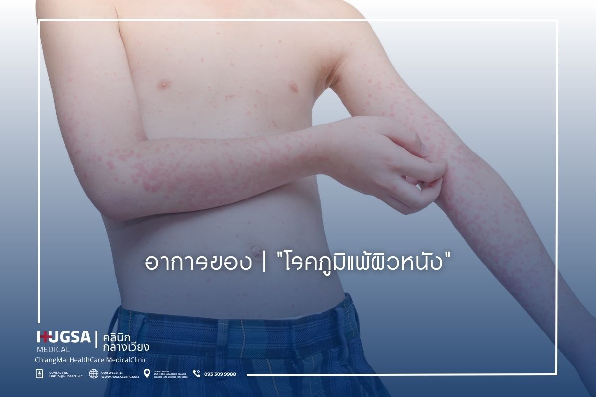 อาการของ โรคภูมิแพ้ผิวหนัง