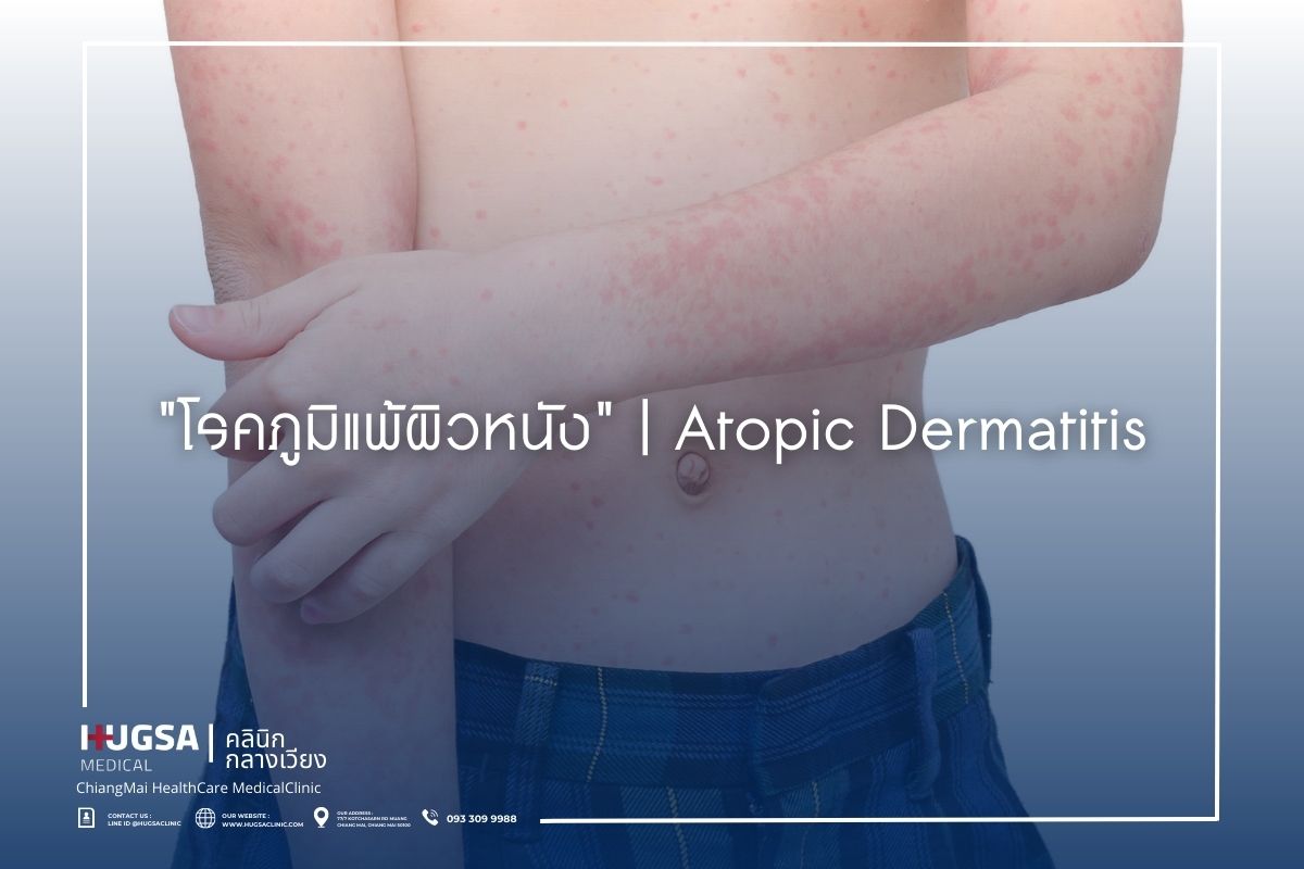 โรคภูมิแพ้ผิวหนัง Atopic Dermatitis