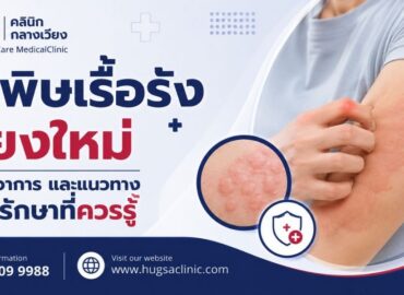 ลมพิษเรื้อรังเชียงใหม่ สาเหตุ อาการ และแนวทางตรวจรักษาที่ควรรู้