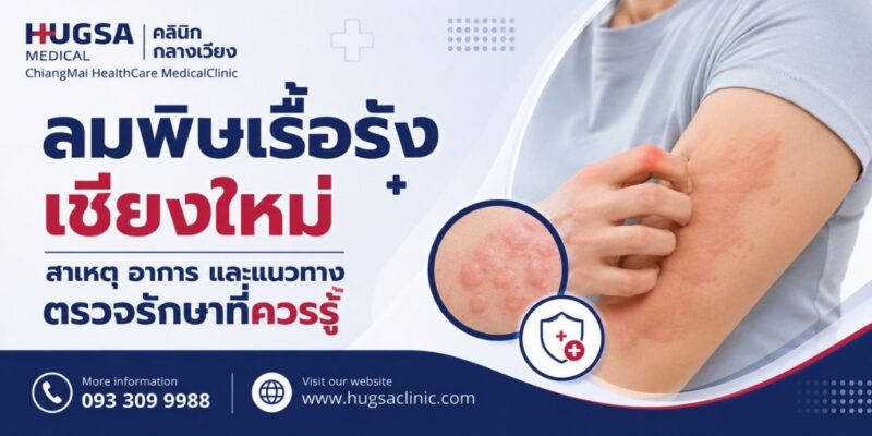 ลมพิษเรื้อรังเชียงใหม่ สาเหตุ อาการ และแนวทางตรวจรักษาที่ควรรู้