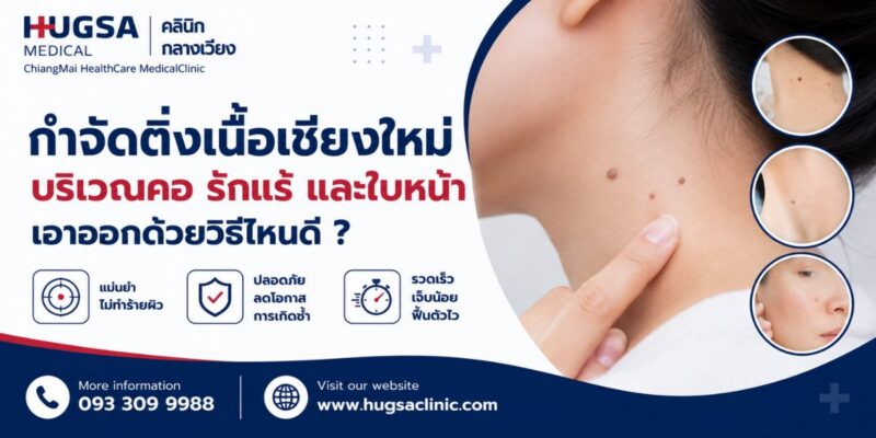 กำจัดติ่งเนื้อเชียงใหม่ บริเวณคอ รักแร้ และใบหน้า เอาออกด้วยวิธีไหนดี