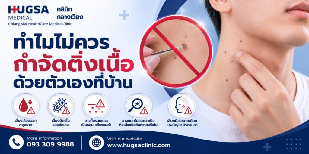 ทำไมไม่ควรกำจัดติ่งเนื้อด้วยตัวเองที่บ้าน