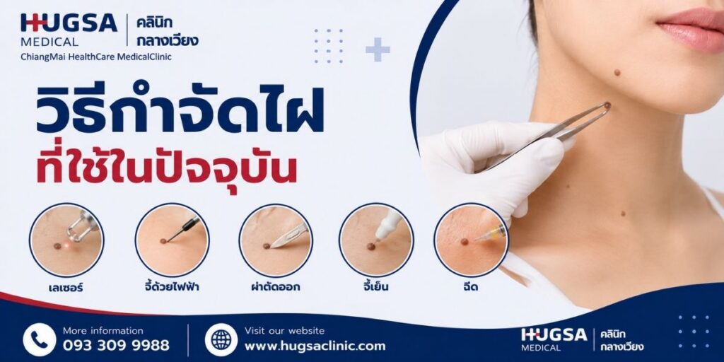 วิธีกำจัดไฝที่ใช้ในปัจจุบัน