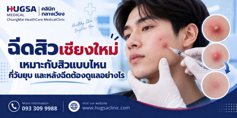 ฉีดสิวเชียงใหม่ เหมาะกับสิวแบบไหน กี่วันยุบ และหลังฉีดต้องดูแลอย่างไร