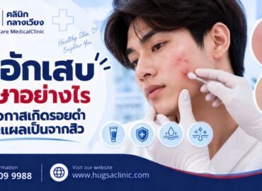 สิวอักเสบ รักษาอย่างไร ลดโอกาสเกิดรอยดำและแผลเป็นจากสิว