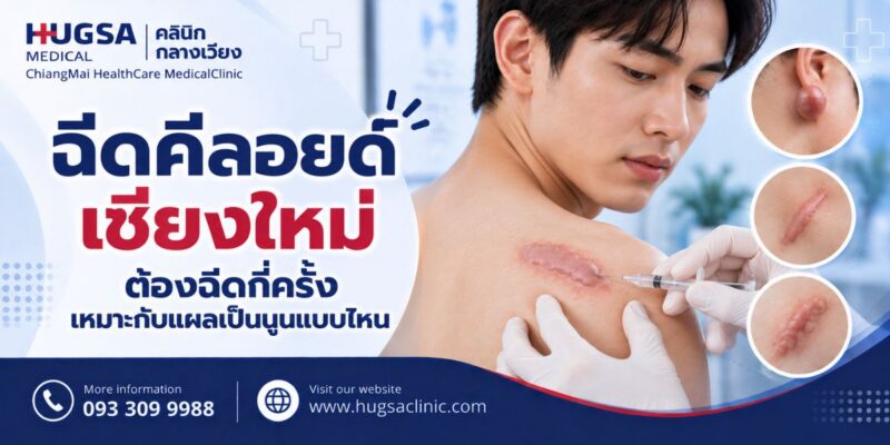 ฉีดคีลอยด์เชียงใหม่ ต้องฉีดกี่ครั้ง เหมาะกับแผลเป็นนูนแบบไหน